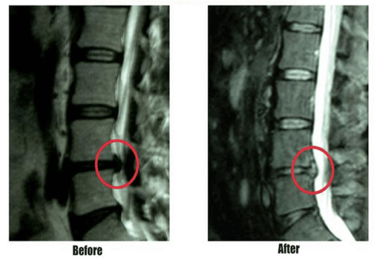IDD Therapy treatment before and after patient MRI with herniated disc.