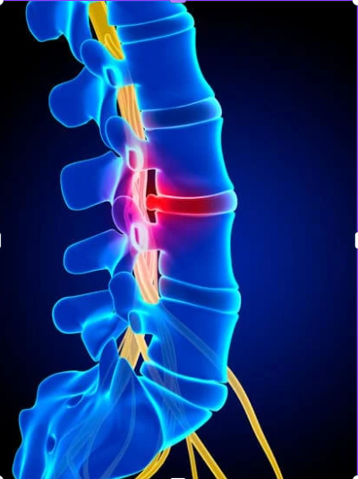 The digital image depicting the spine with herniation